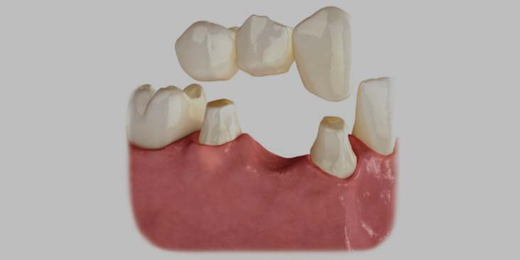 Replacing your bridge with dental implants.