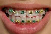 Metal braces with colored bands are a type of traditional braces treatment