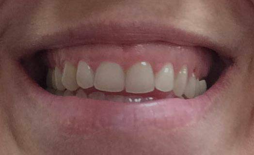 Gum lifts are a cosmetic dentistry option for fixing a gummy smile.