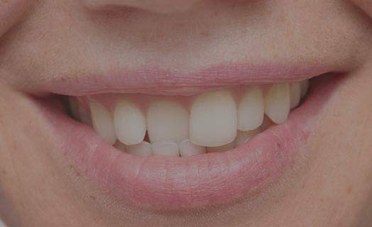 The most common cosmetic dentistry option is braces and orthodontics.