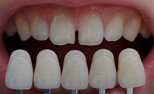 Dental veneers are a cosmetic dentistry option that give your teeth an entirely new look.