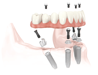 All-on-4 dental implants replace missing or failing teeth.