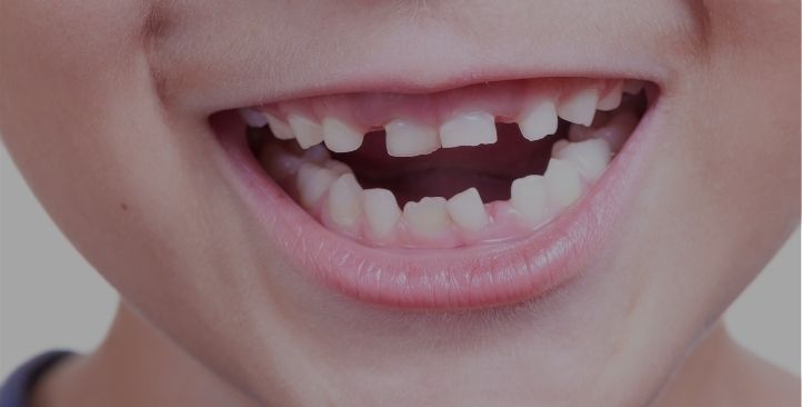 Read why do baby teeth matter in our blog.