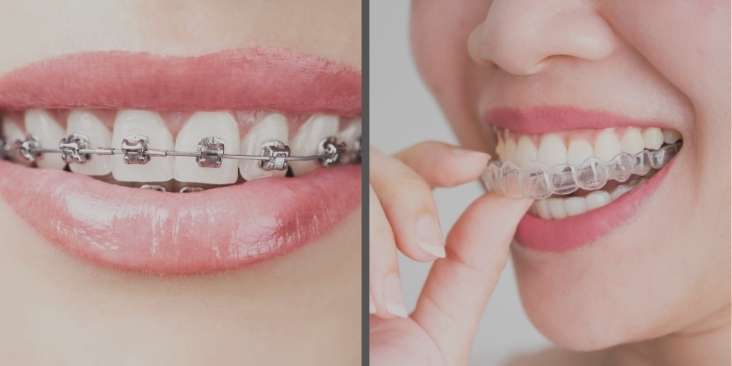 Traditional braces vs. Invisalign clear aligners. Learn the differences.