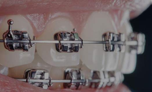 Learn about orthodontic treatment with traditional braces.