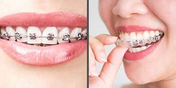 Comparing Treatment Capabilities: Invisalign and Traditional Metal Braces